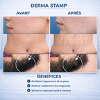 Derma Stamp Adjustable